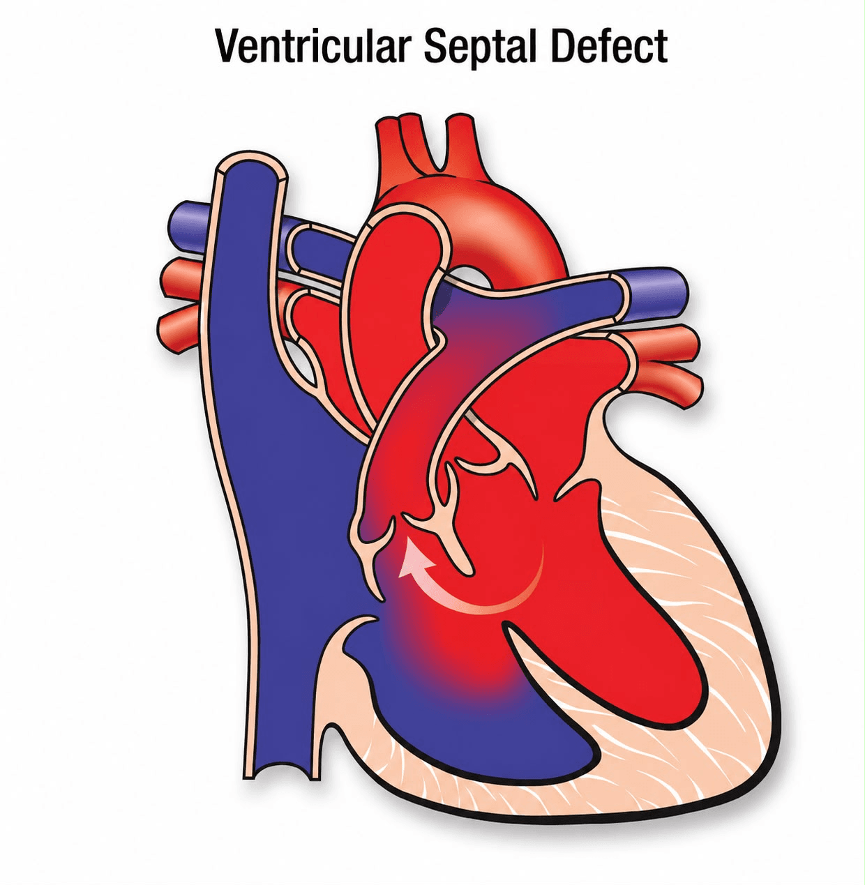 Diagram of a heart with a ventricular septal defect, showing blood crossing between the ventricles